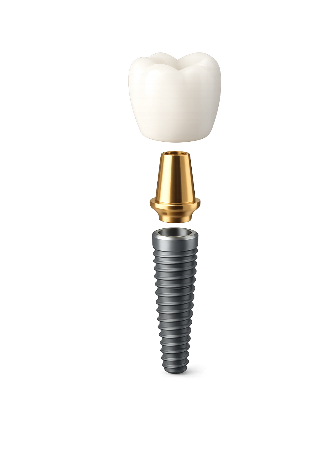 Implante, pilar y corona — DentarteTJ